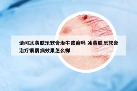 请问冰黄肤乐软膏治牛皮癣吗 冰黄肤乐软膏治疗银屑病效果怎么样