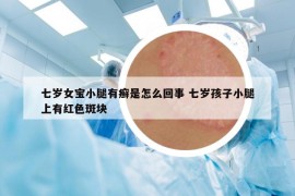 七岁女宝小腿有癣是怎么回事 七岁孩子小腿上有红色斑块