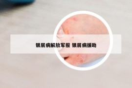 银屑病解放军报 银屑病援助