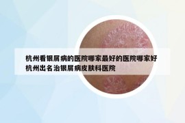 杭州看银屑病的医院哪家最好的医院哪家好 杭州出名治银屑病皮肤科医院