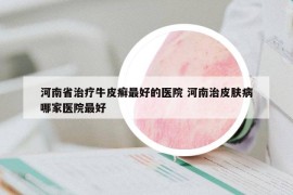 河南省治疗牛皮癣最好的医院 河南治皮肤病哪家医院最好