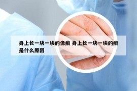 身上长一块一块的像癣 身上长一块一块的癣是什么原因