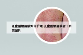 儿童副银屑病如何护理 儿童副银屑病留下白斑图片