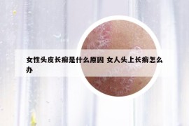 女性头皮长癣是什么原因 女人头上长癣怎么办