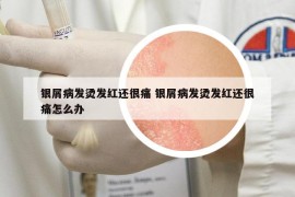 银屑病发烫发红还很痛 银屑病发烫发红还很痛怎么办