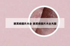 腋窝癣图片大全 腋窝癣图片大全大图