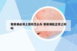 银屑病必须上夜班怎么办 银屑病能正常上班吗