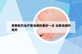 用那些药治疗银消病效果好一点 治银消病外用药