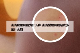 点滴状银屑病为什么痒 点滴型银屑病起皮多是什么期