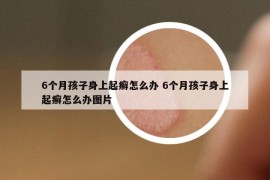 6个月孩子身上起癣怎么办 6个月孩子身上起癣怎么办图片