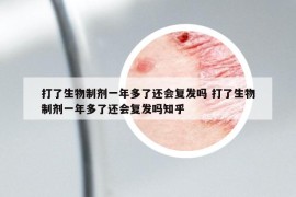 打了生物制剂一年多了还会复发吗 打了生物制剂一年多了还会复发吗知乎