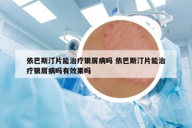 依巴斯汀片能治疗银屑病吗 依巴斯汀片能治疗银屑病吗有效果吗