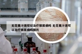 无花果汁液可以治疗银屑病吗 无花果汁液可以治疗银屑病吗图片