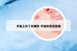 手指上长了白癜风 手指出现白斑病