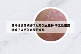 寻常性银屑病好了以后怎么维护 寻常性银屑病好了以后怎么维护皮肤