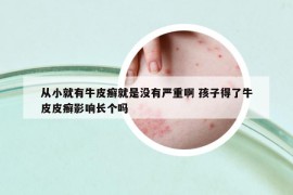 从小就有牛皮癣就是没有严重啊 孩子得了牛皮皮癣影响长个吗