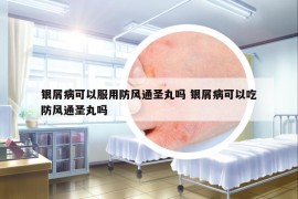 银屑病可以服用防风通圣丸吗 银屑病可以吃防风通圣丸吗