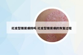 红皮型银屑病样吗 红皮型银屑病的恢复过程