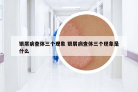 银屑病查体三个现象 银屑病查体三个现象是什么