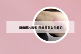 阴癣图片搜索 阴癣是怎么引起的