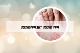 皮肤病白斑治疗 皮肤病 白斑