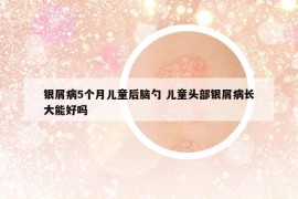 银屑病5个月儿童后脑勺 儿童头部银屑病长大能好吗