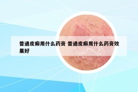 普通皮癣用什么药膏 普通皮癣用什么药膏效果好