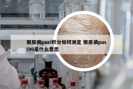 银屑病pasi积分如何测定 银屑病pasi90是什么意思