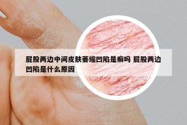 屁股两边中间皮肤萎缩凹陷是癣吗 屁股两边凹陷是什么原因