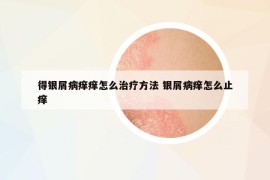 得银屑病痒痒怎么治疗方法 银屑病痒怎么止痒