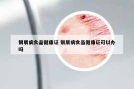 银屑病食品健康证 银屑病食品健康证可以办吗