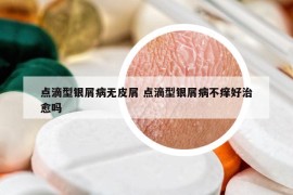 点滴型银屑病无皮屑 点滴型银屑病不痒好治愈吗