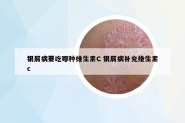 银屑病要吃哪种维生素C 银屑病补充维生素c