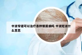 中波窄谱可以治疗各种银屑病吗 中波短波什么意思