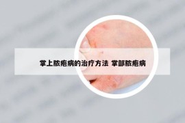 掌上脓疱病的治疗方法 掌部脓疱病