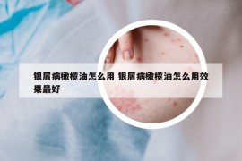 银屑病橄榄油怎么用 银屑病橄榄油怎么用效果最好