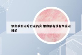 银血病的治疗方法药膏 银血病有没有彻底治好的