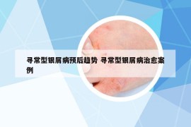 寻常型银屑病预后趋势 寻常型银屑病治愈案例