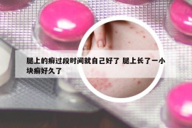 腿上的癣过段时间就自己好了 腿上长了一小块癣好久了