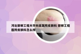 河北邯郸工程大学附属医院皮肤科 邯郸工程医院皮肤科怎么样