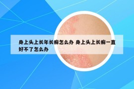 身上头上长年长癣怎么办 身上头上长癣一直好不了怎么办