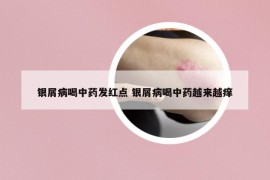 银屑病喝中药发红点 银屑病喝中药越来越痒