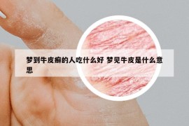 梦到牛皮癣的人吃什么好 梦见牛皮是什么意思