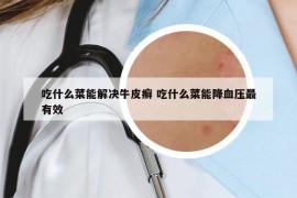 吃什么菜能解决牛皮癣 吃什么菜能降血压最有效