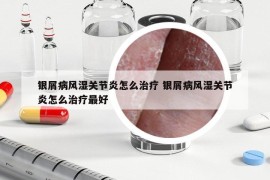 银屑病风湿关节炎怎么治疗 银屑病风湿关节炎怎么治疗最好