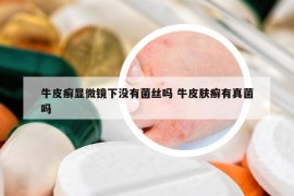 牛皮癣显微镜下没有菌丝吗 牛皮肤癣有真菌吗