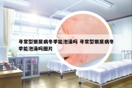 寻常型银屑病冬季能泡澡吗 寻常型银屑病冬季能泡澡吗图片