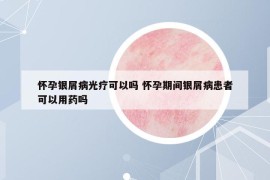 怀孕银屑病光疗可以吗 怀孕期间银屑病患者可以用药吗