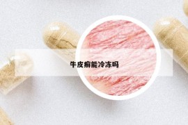 牛皮癣能冷冻吗