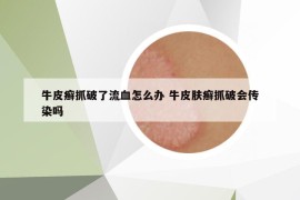 牛皮癣抓破了流血怎么办 牛皮肤癣抓破会传染吗